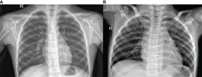 Performance Evaluation of the Deep Learning Based Convolutional Neural Network Approach for the Recognition of Chest X-Ray Images